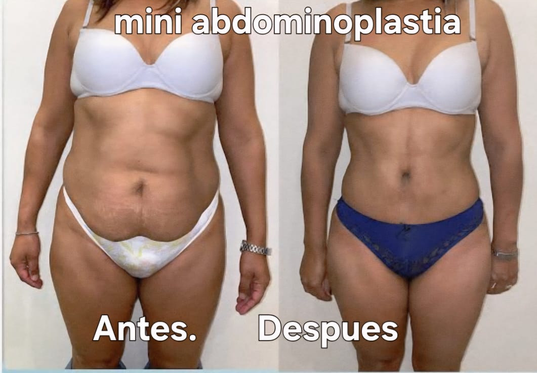 Resultado Miniabdominoplastia 4